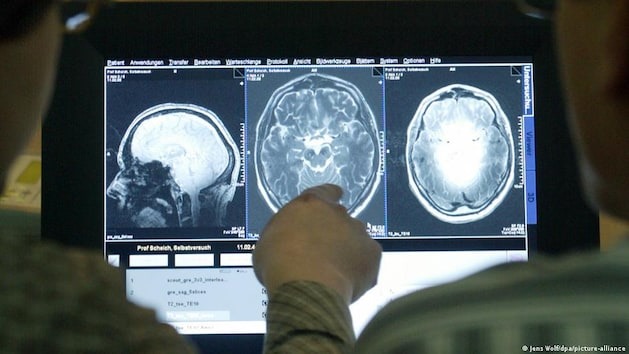 Durchbruch in der Alzheimer-Forschung: Warum sterben Gehirnzellen ab?